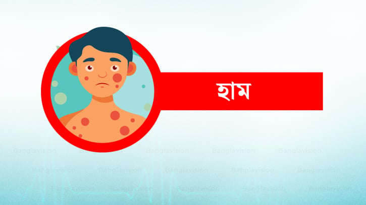 হাম উপসর্গে মৃত্যুর সংখ্যা ৬০০ ছাড়ালো 